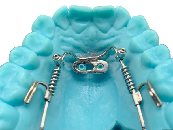 Distal2 aligners